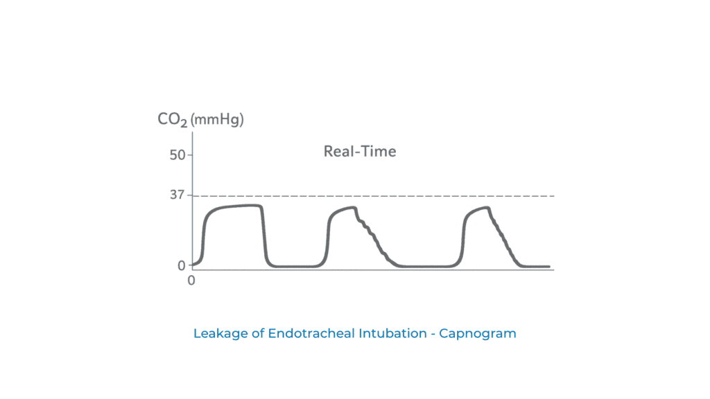 Capnogram of Leakage of Endotracheal Intubation