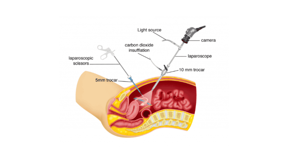 Detection of CO₂ Retention During Laparoscopic Surgeries